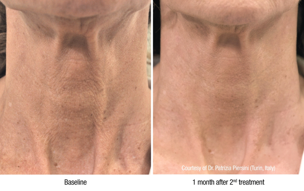 Profhilo treatment Petaling Jaya