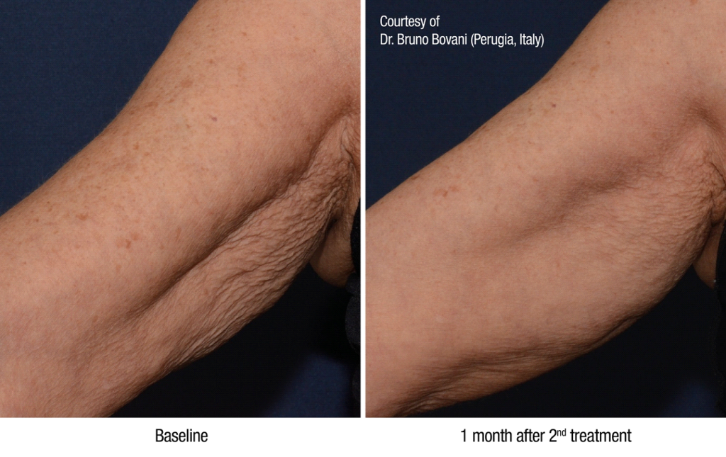 Profhilo treatment Petaling Jaya
