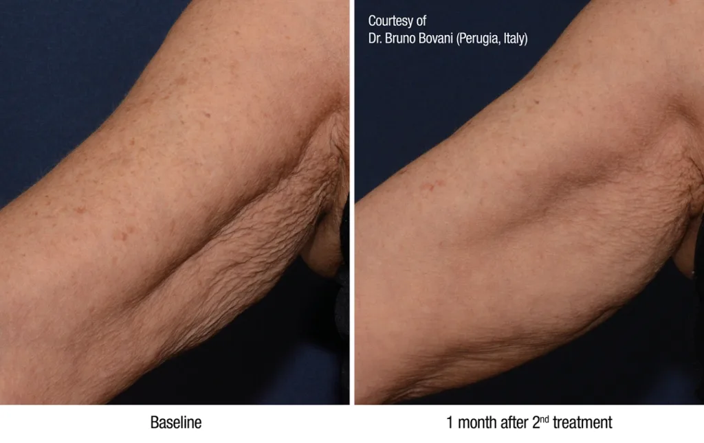 Profhilo treatment Petaling Jaya