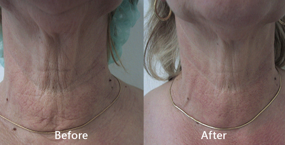 plienst treatment Petaling Jaya