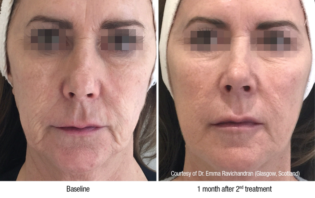 profhilo results