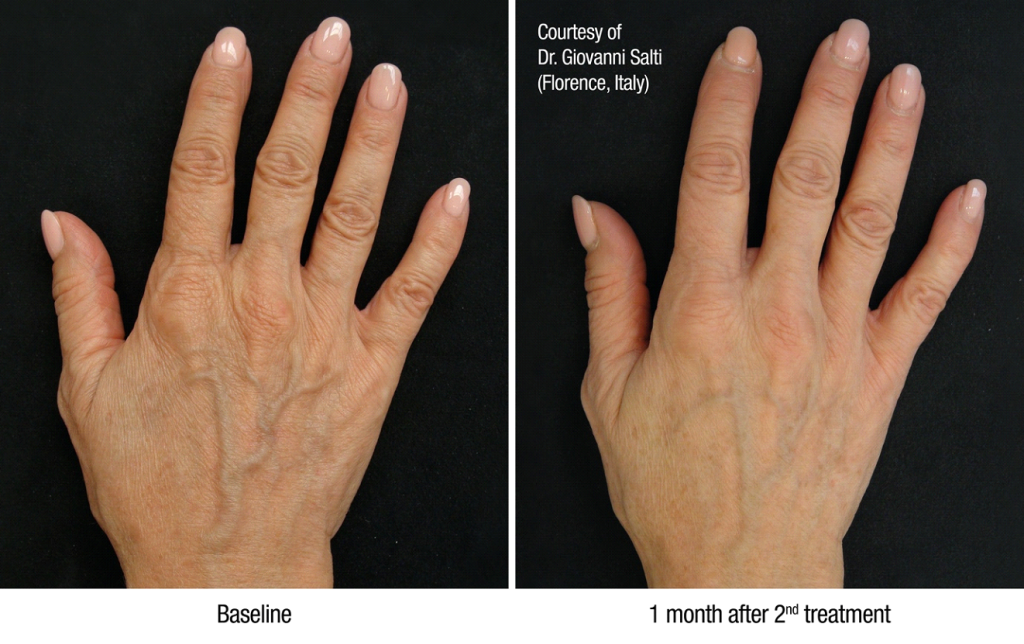 profhilo treatment results