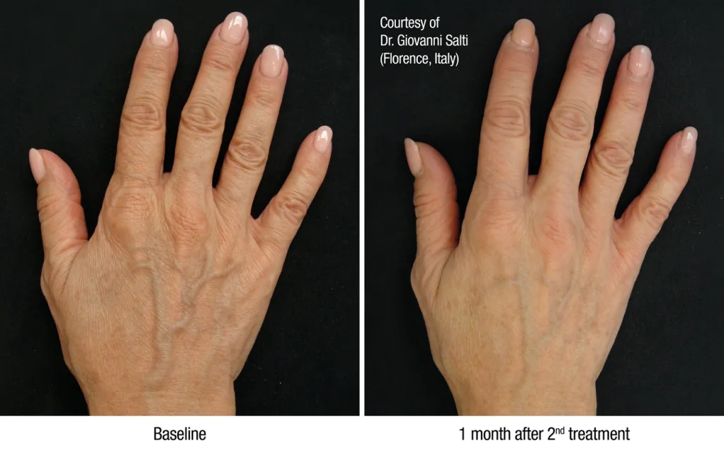 profhilo treatment results
