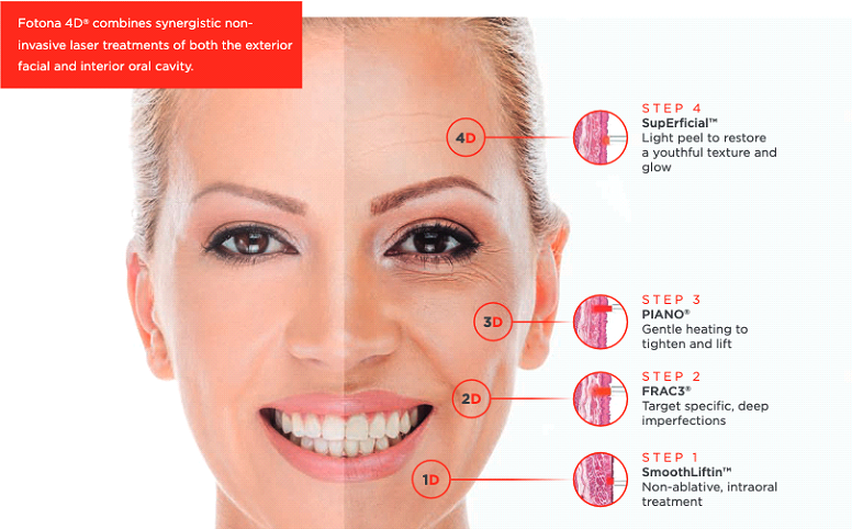 fotona 4d treatment Petaling Jaya