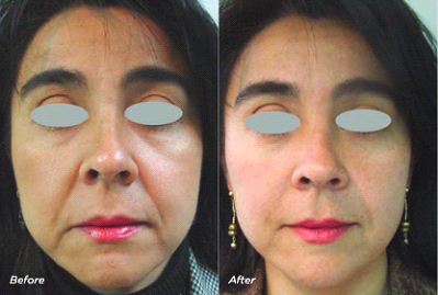 fotona 4d