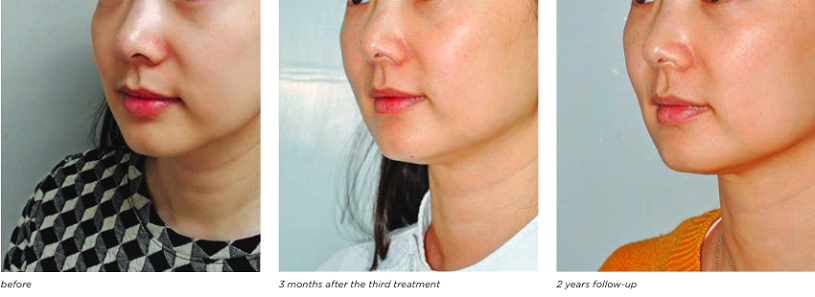 Non-invasive Laser Facelift