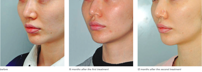 Revolutionary Non-invasive Laser Facelift