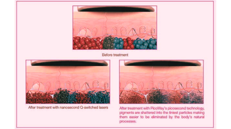 Picoway® Laser Precision Treatment Malaysia