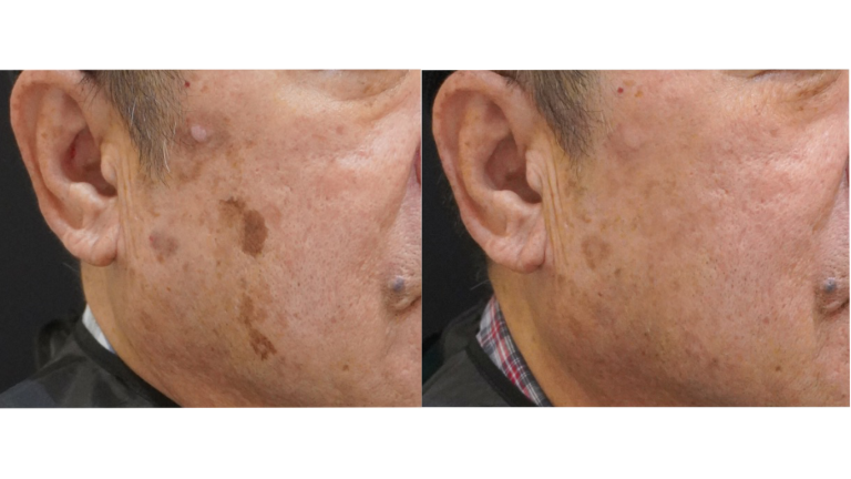 Picoway® Laser Precision Treatment Malaysia