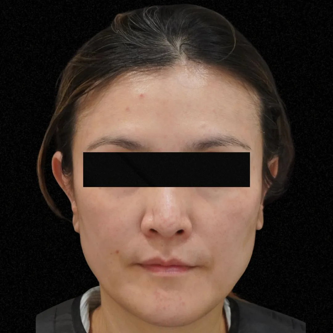 Aesthefill treatment Petaling Jaya