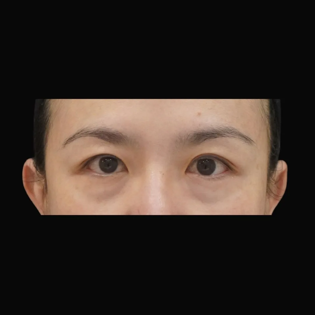 Aesthefill treatment Petaling Jaya
