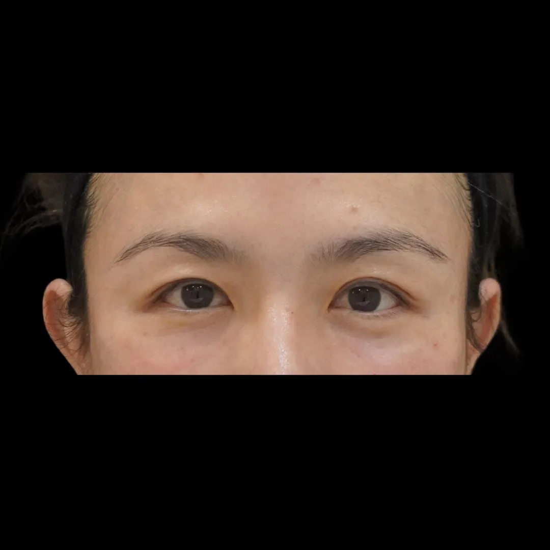 Aesthefill treatment Petaling Jaya