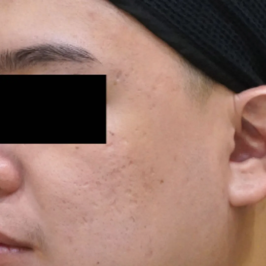 Aesthefill treatment Petaling Jaya