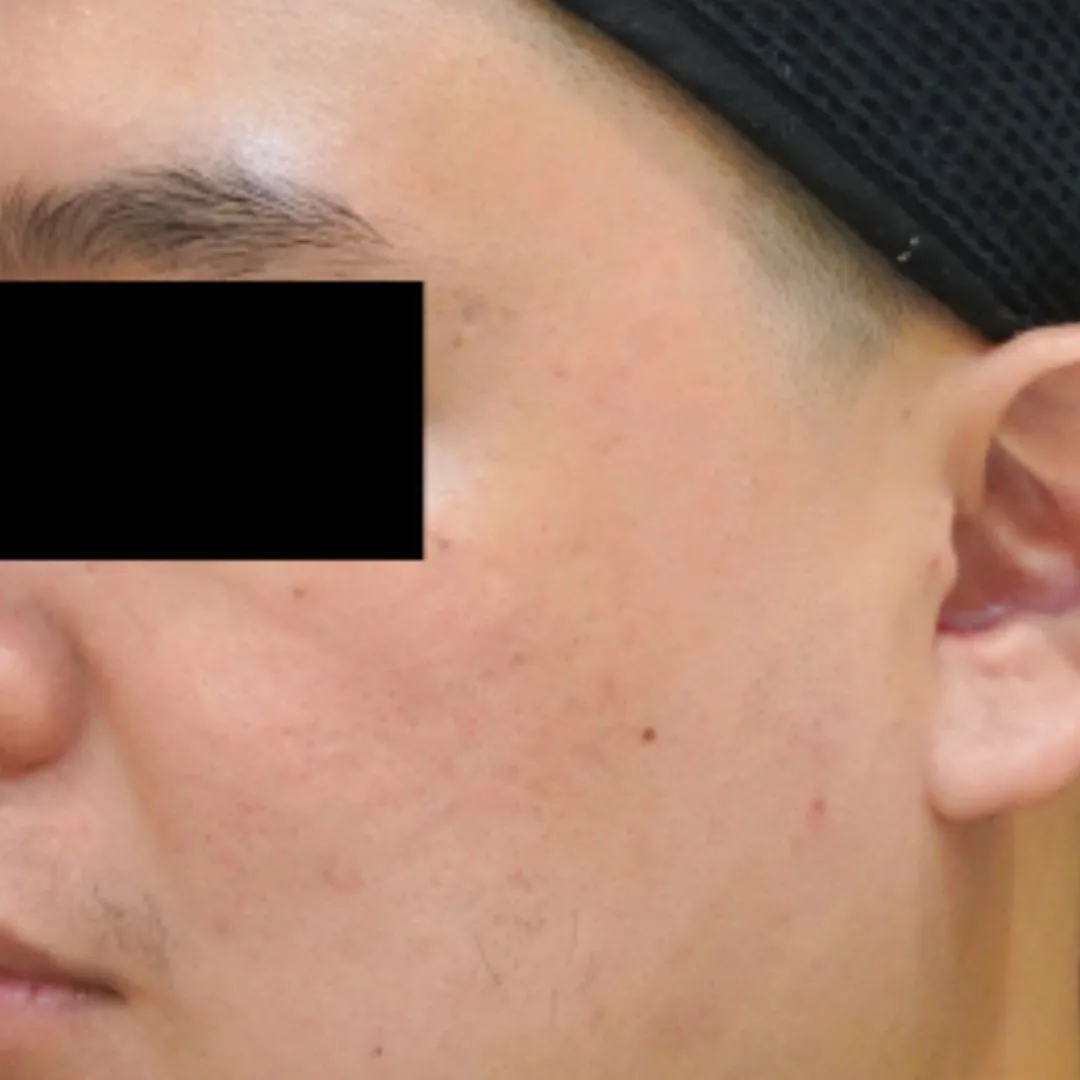 Aesthefill treatment Petaling Jaya