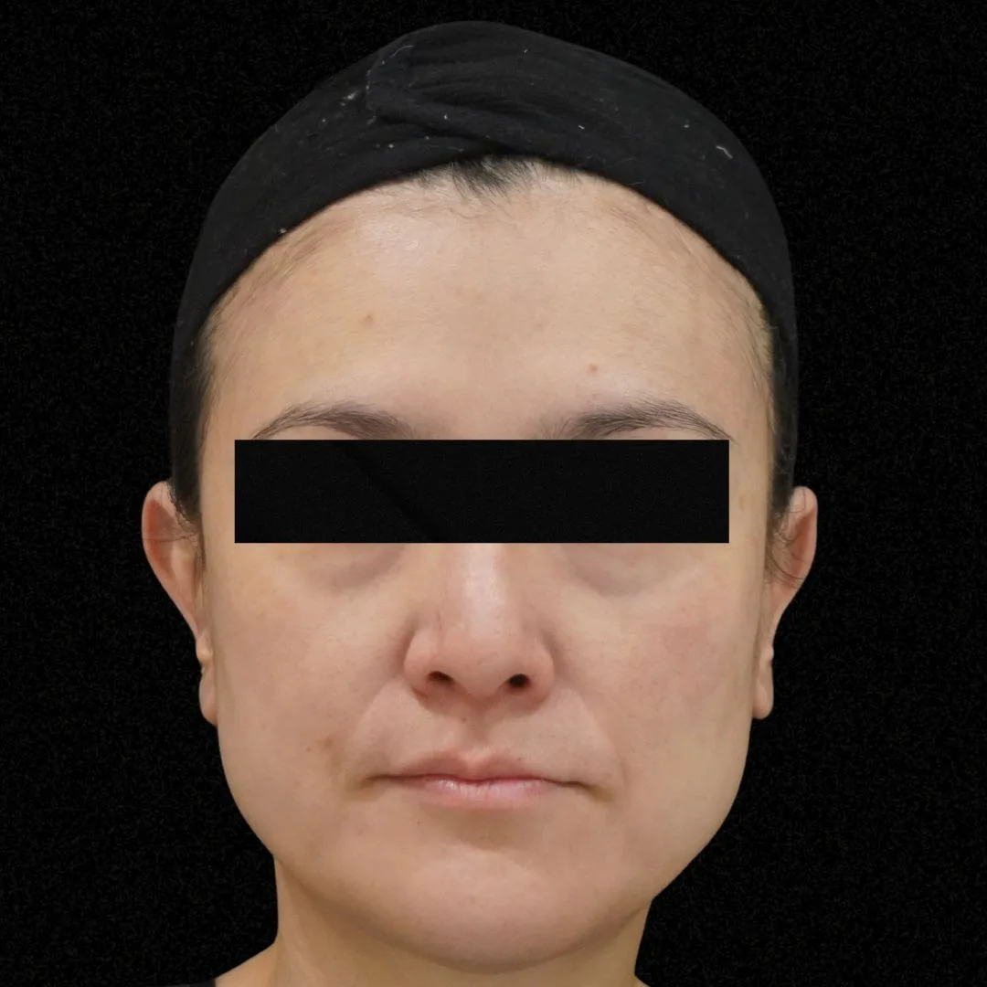 Aesthefill treatment Petaling Jaya