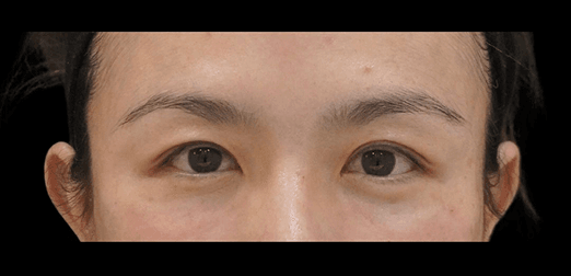 Aesthefill after
