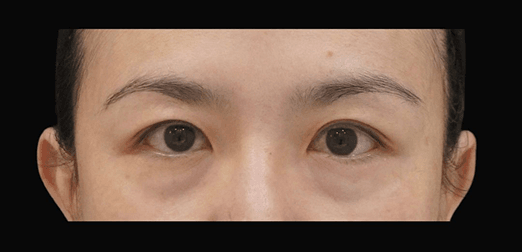 Aesthefill before Aesthefill before