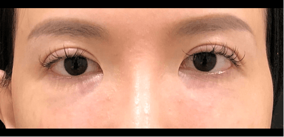 Dermal fillers After