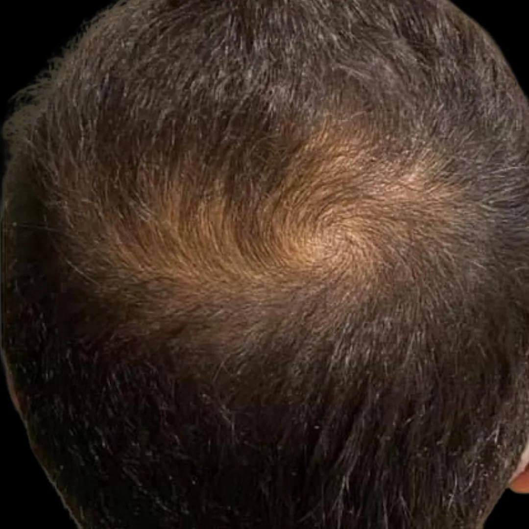 Fotona HAIRestart® Laser Petaling Jaya