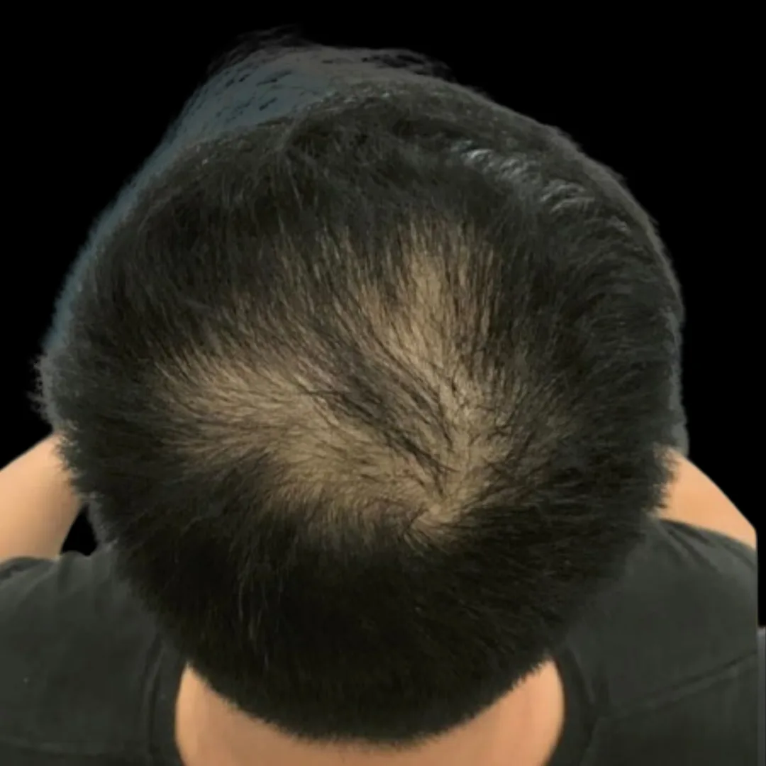 Fotona HAIRestart® Laser Petaling Jaya