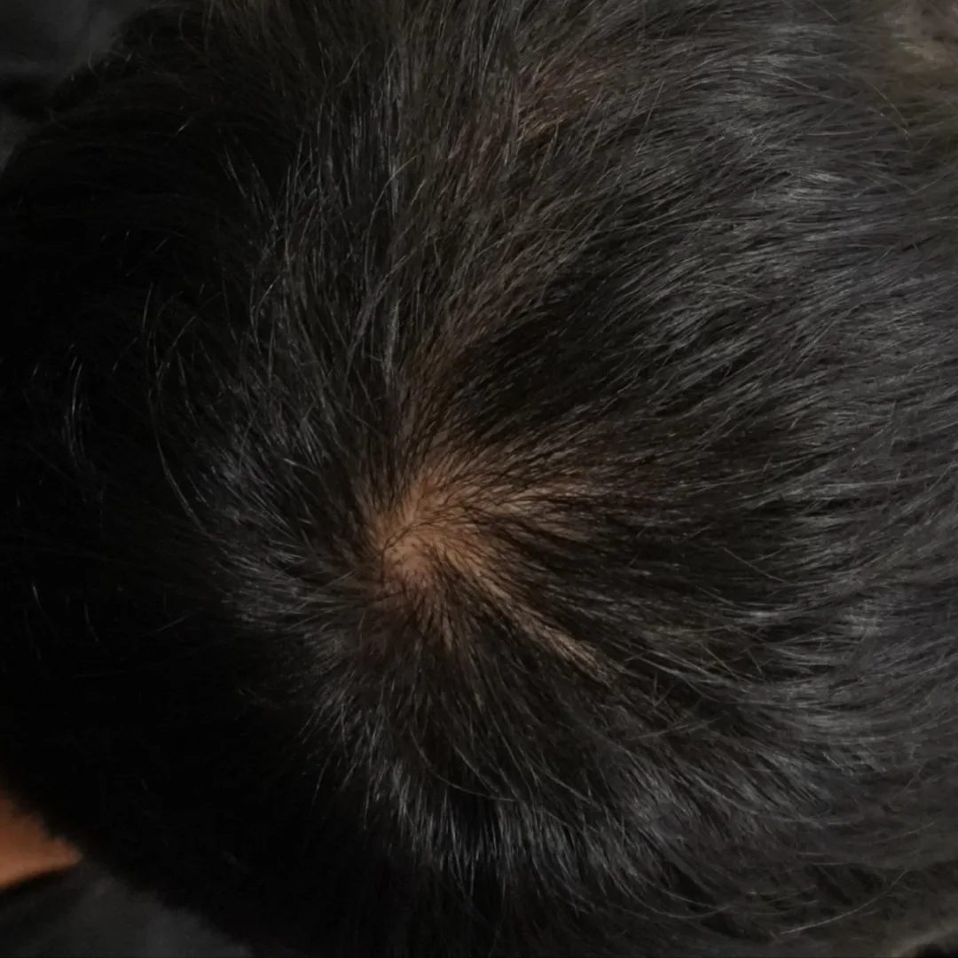 Fotona HAIRestart® Laser Petaling Jaya