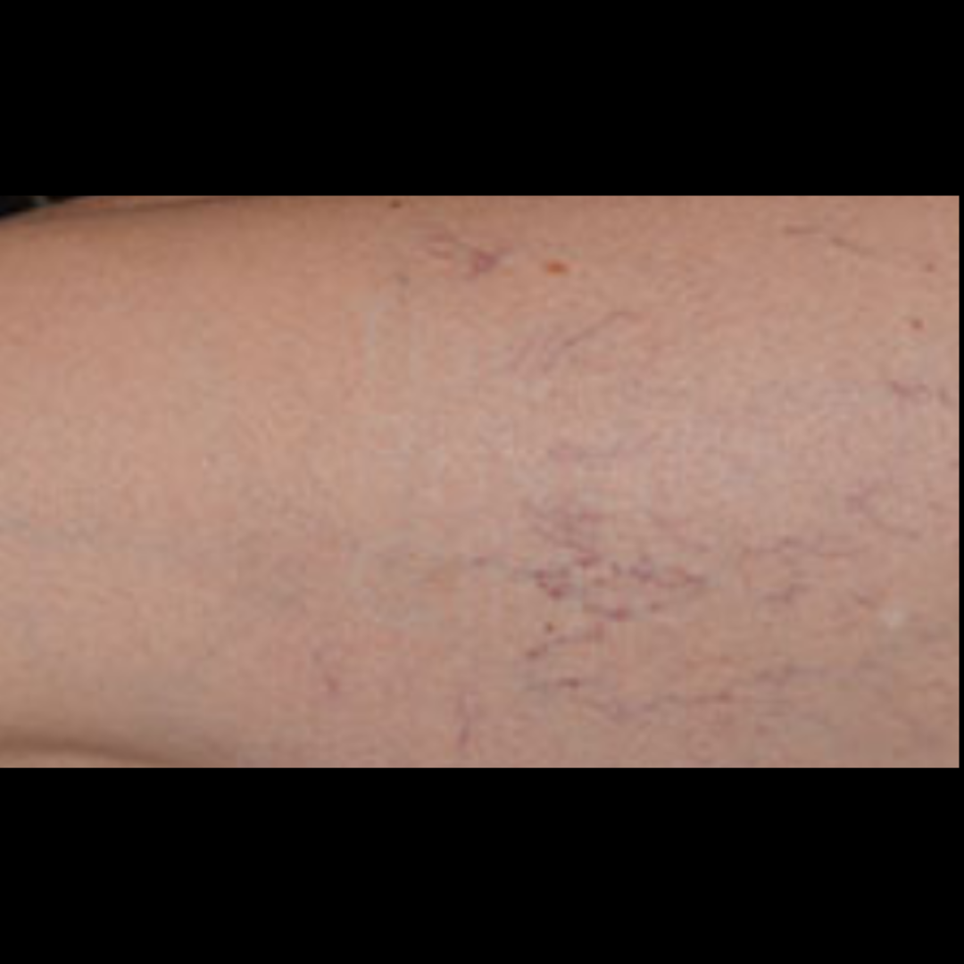 _Fotona SP Dynamis Pro Laser (Spider Veins) (1)