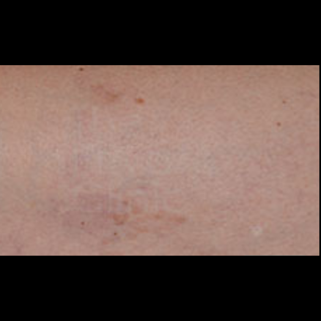 _Fotona SP Dynamis Pro Laser (Spider Veins) (2)
