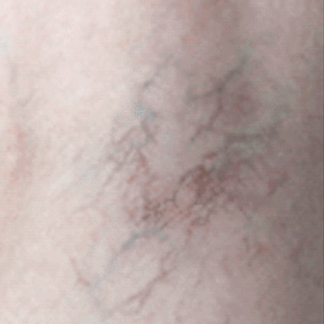_Fotona SP Dynamis Pro Laser (Spider Veins) (3)