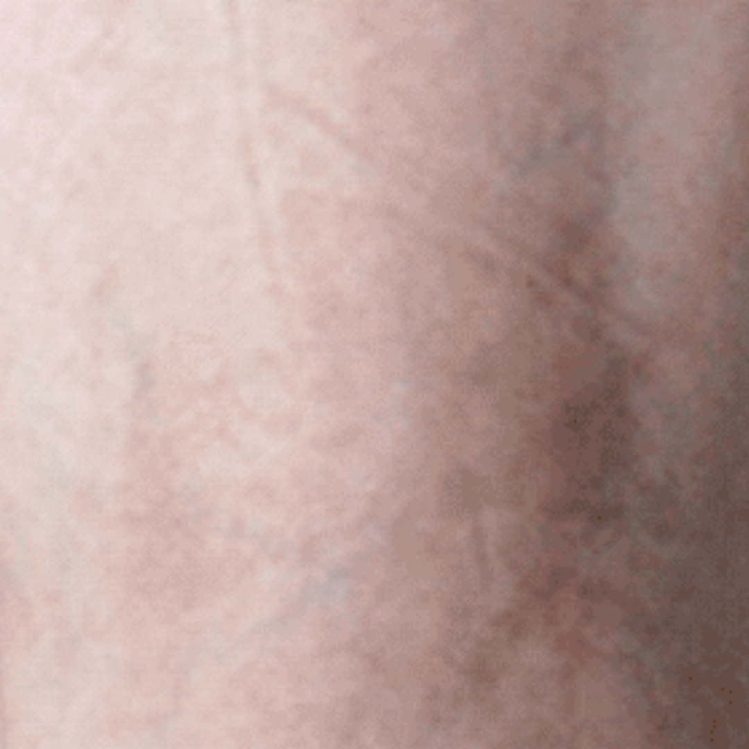 _Fotona SP Dynamis Pro Laser (Spider Veins) (4)