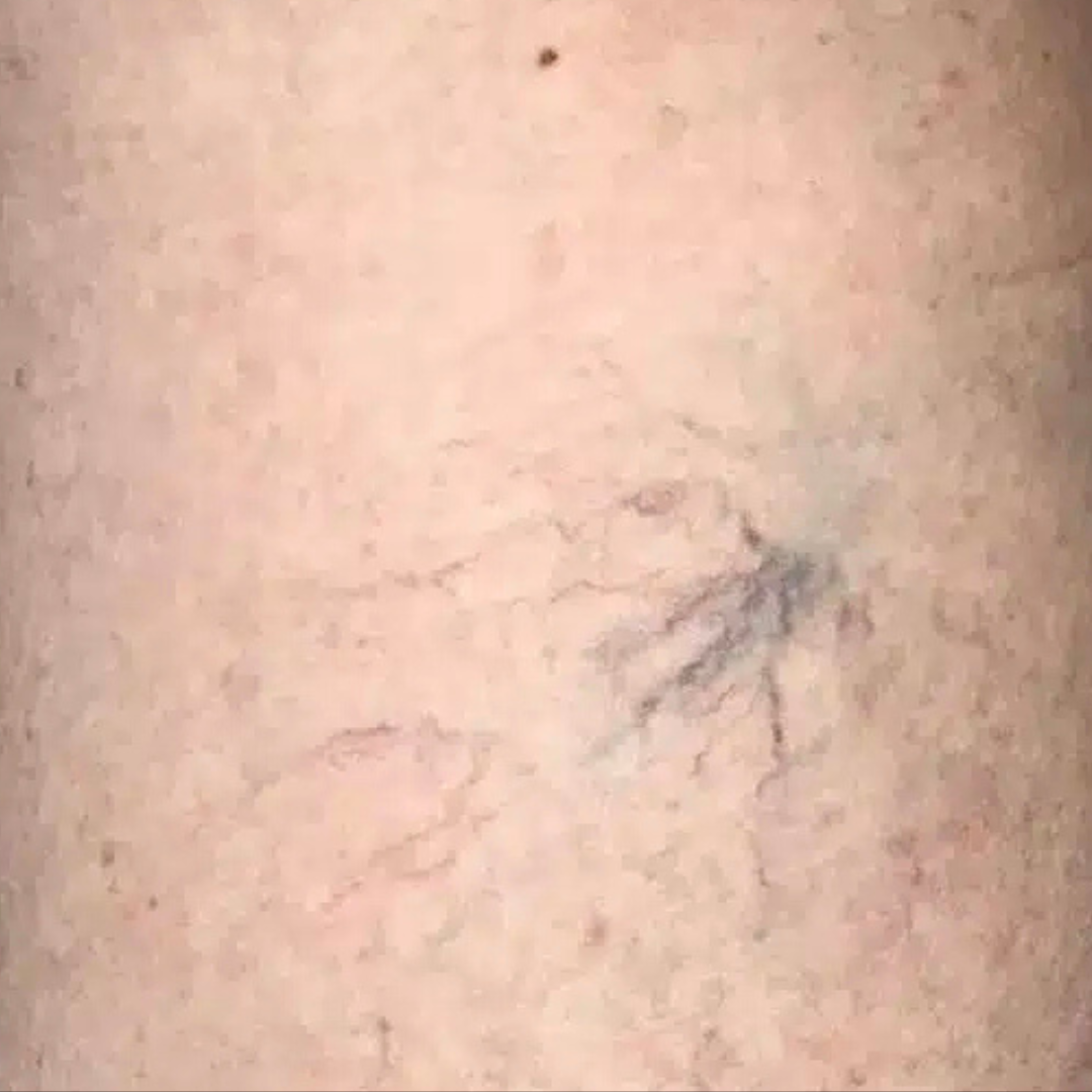 _Fotona SP Dynamis Pro Laser (Spider Veins) (5)
