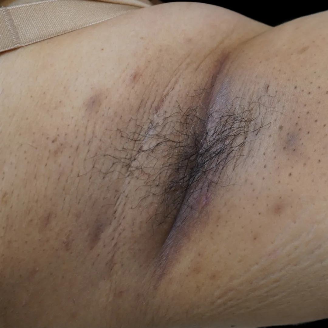 Fotona hair removal (1)