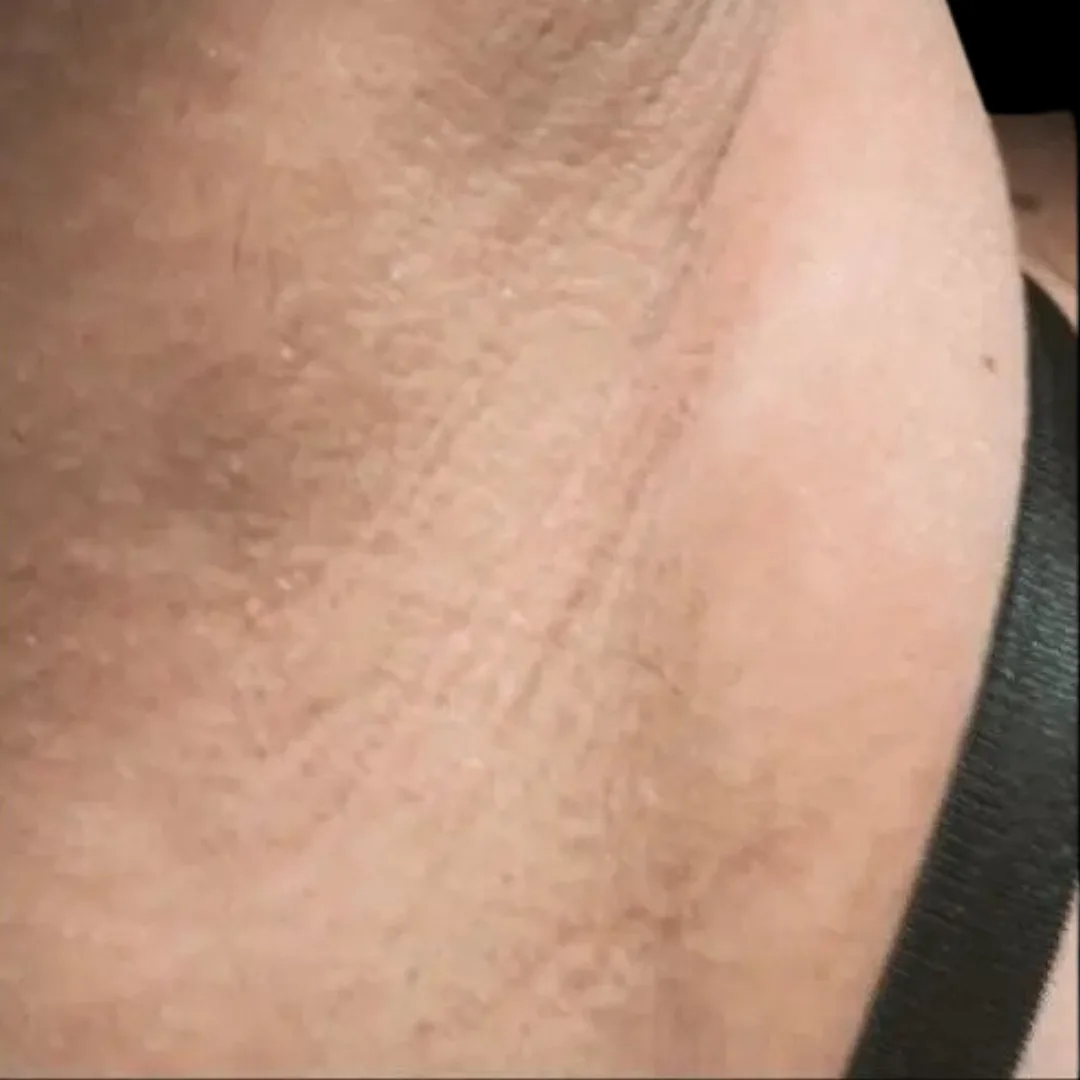 Fotona hair removal (4)