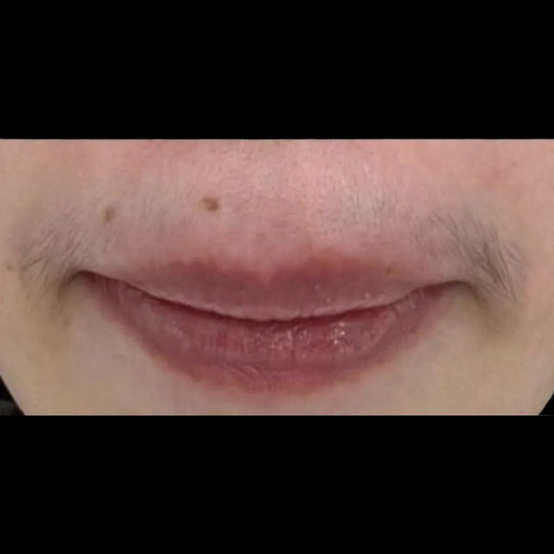 Fotona hair removal (5)