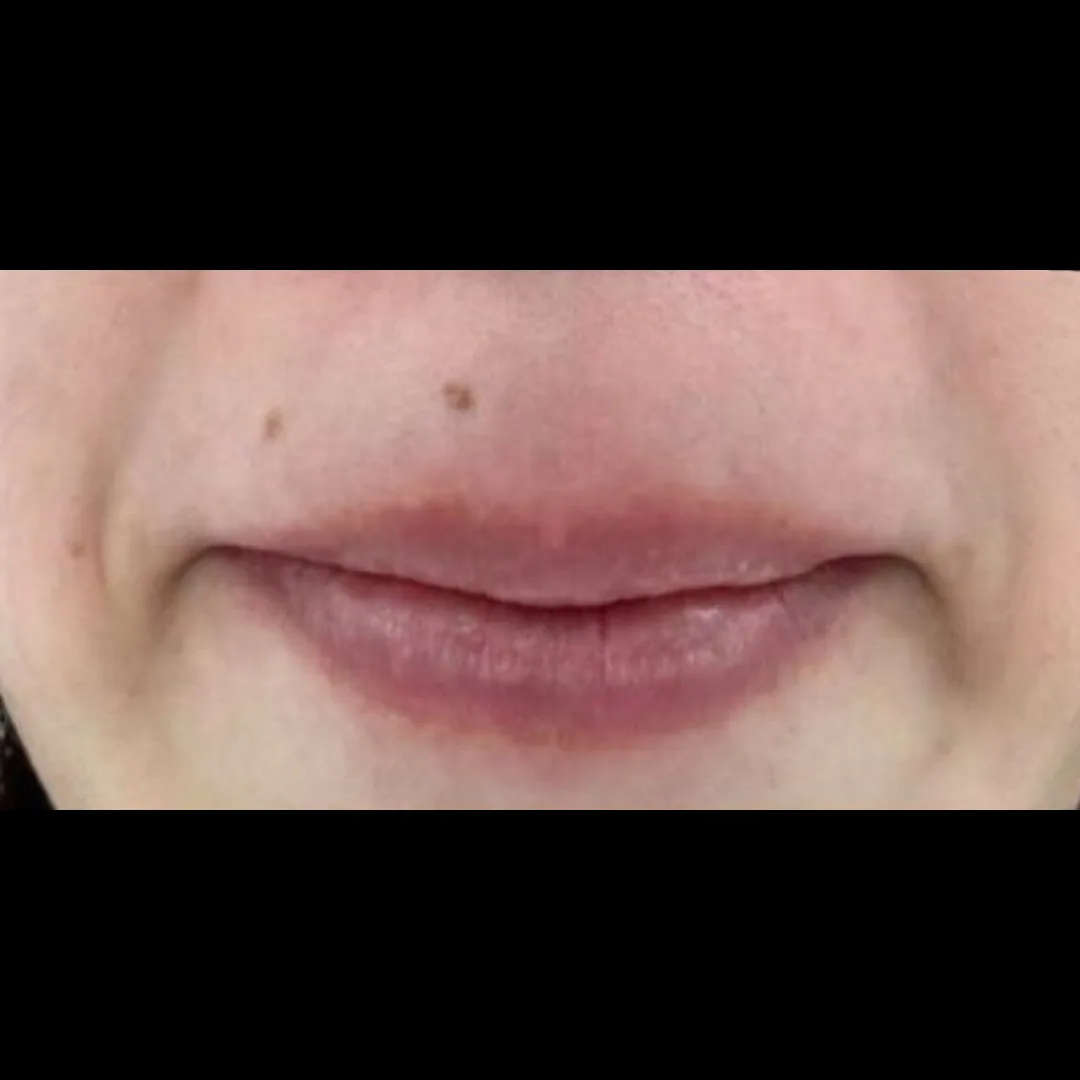 Fotona hair removal (6)