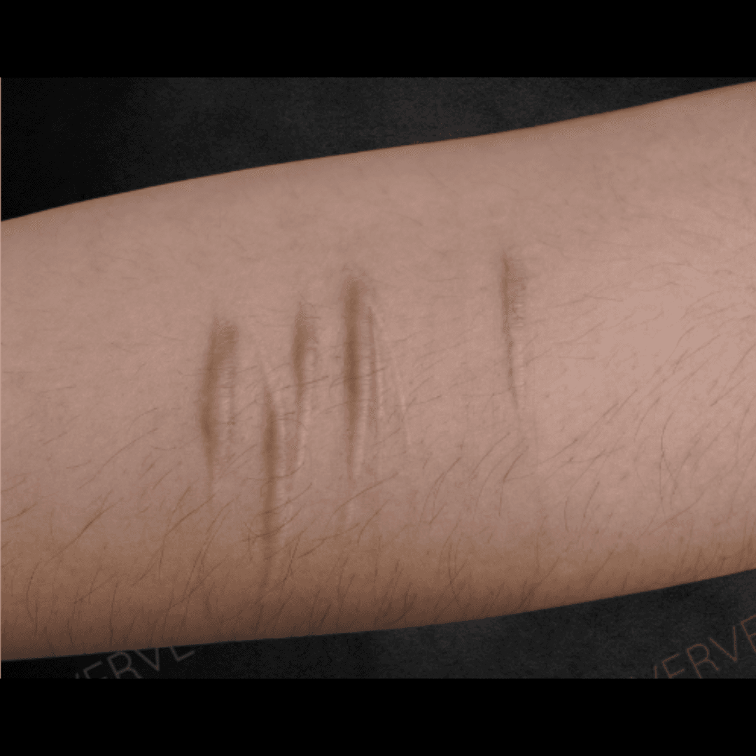 _Intralesional Corticosteroid Injection (Keloid Scars Removal) (1)
