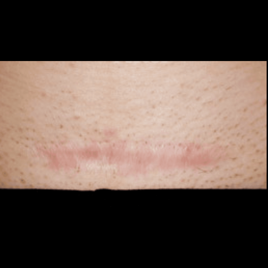 _Intralesional Corticosteroid Injection (Keloid Scars Removal) (6)