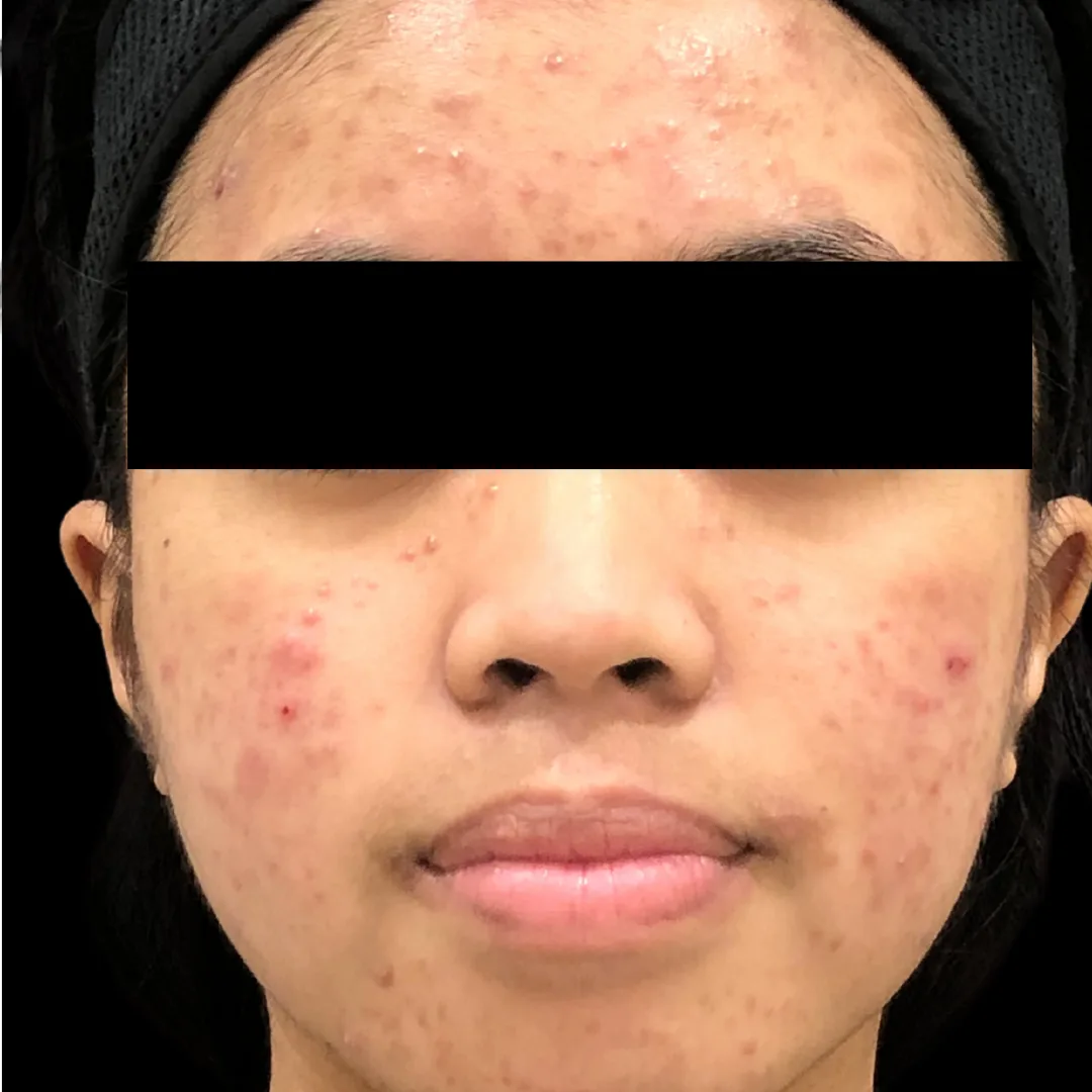 Medical Facial & Chemical Peel (3)