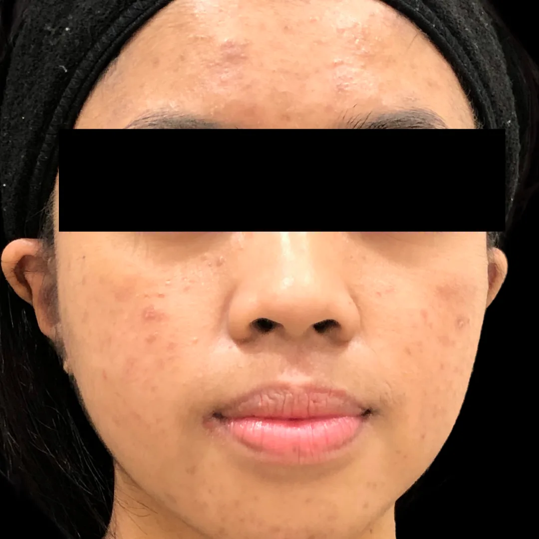 Medical Facial & Chemical Peel (4)