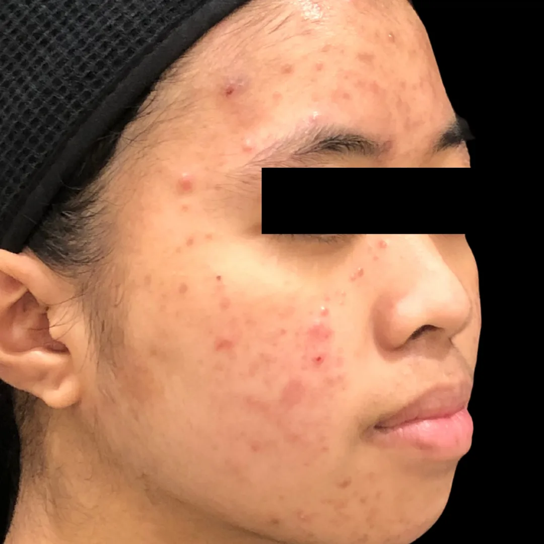Medical Facial & Chemical Peel (5)