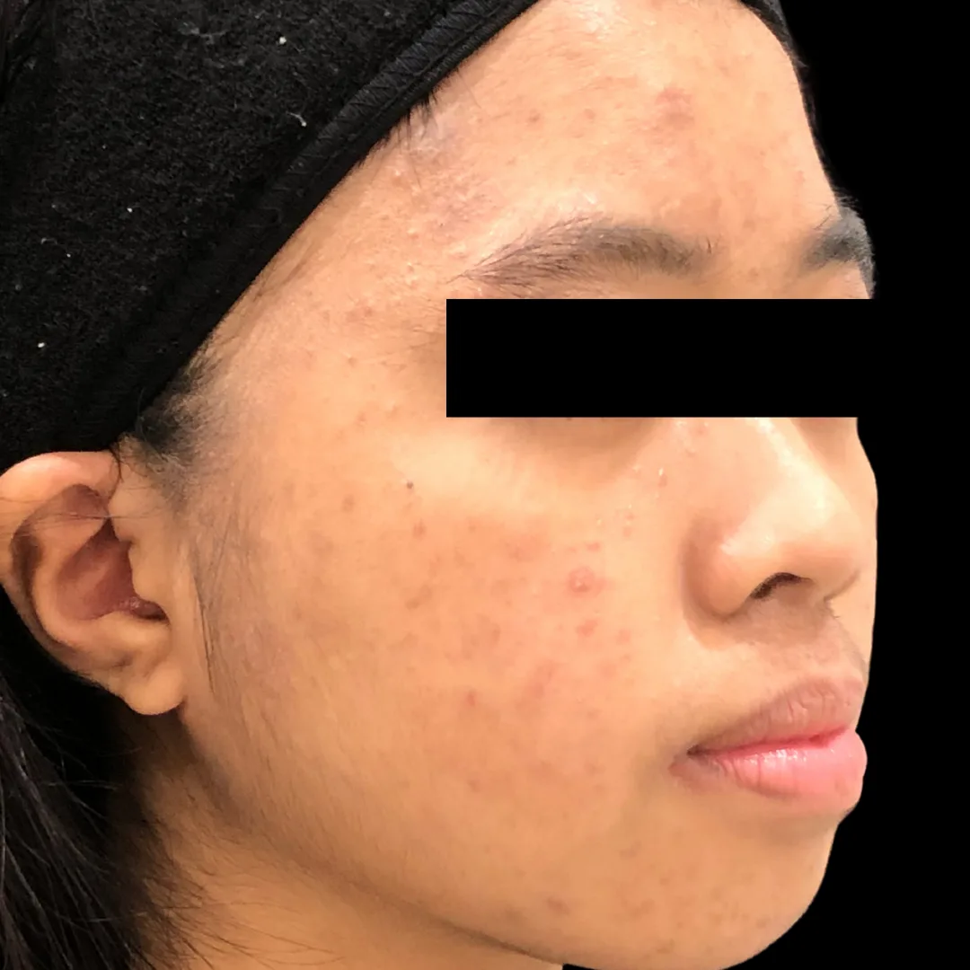 Medical Facial & Chemical Peel (6)