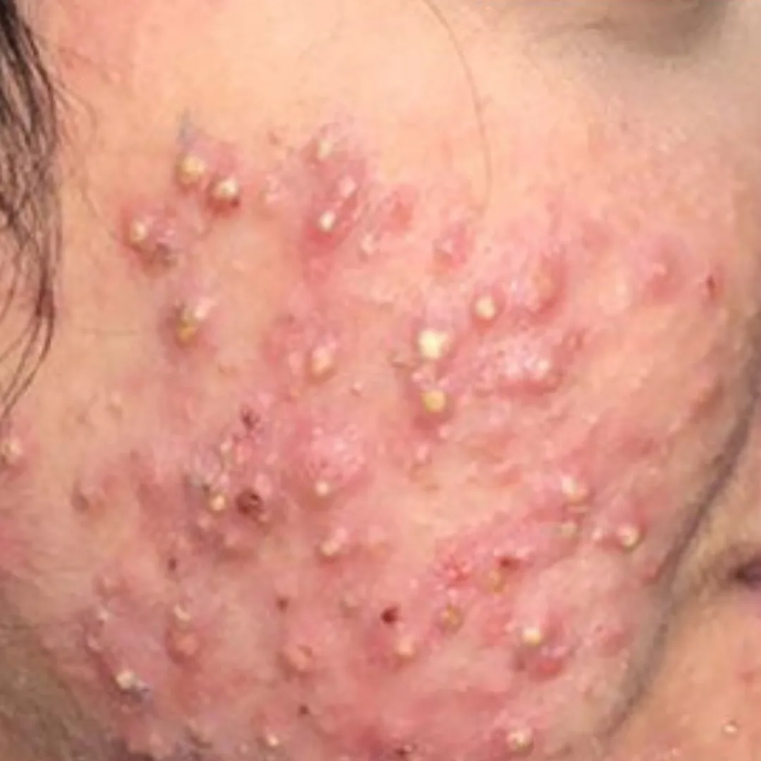 Medical facial & chemical peel (1)