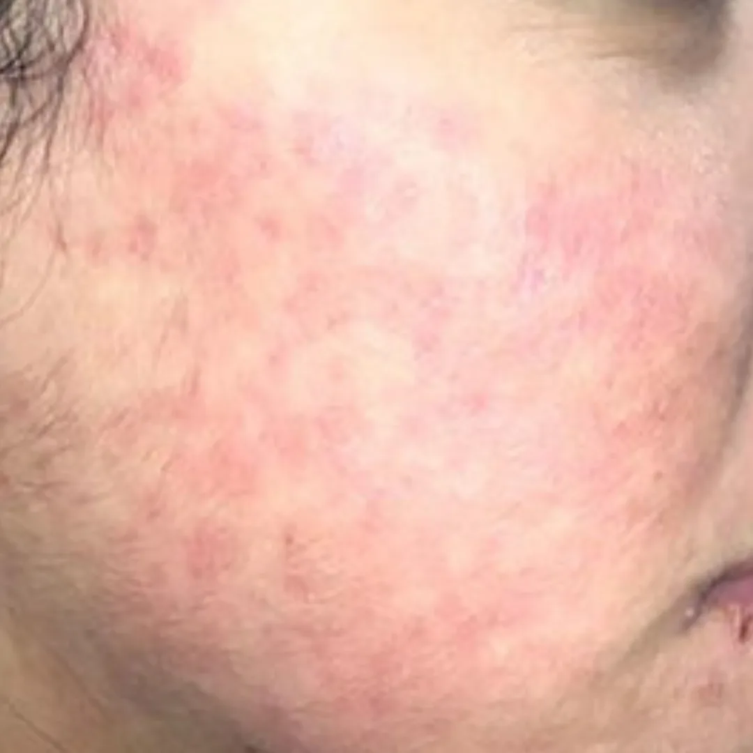 Medical facial & chemical peel (2)