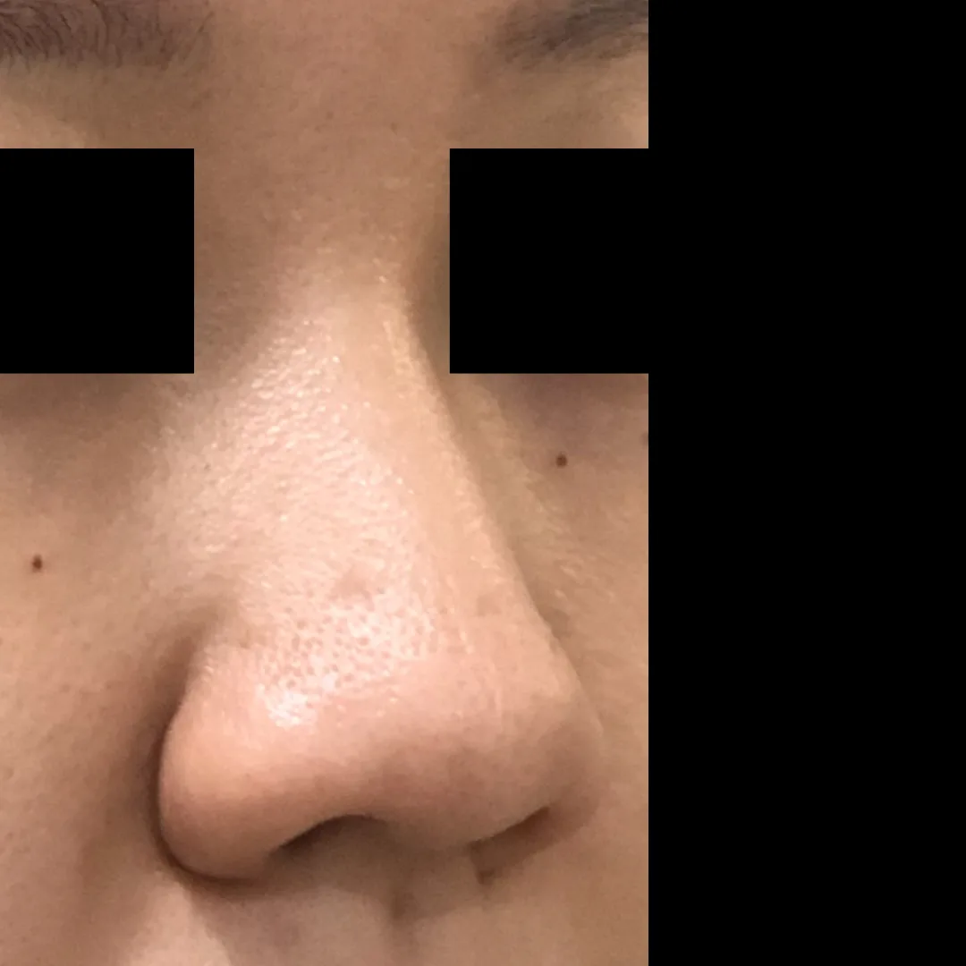 Nose thread lift Petaling Jaya
