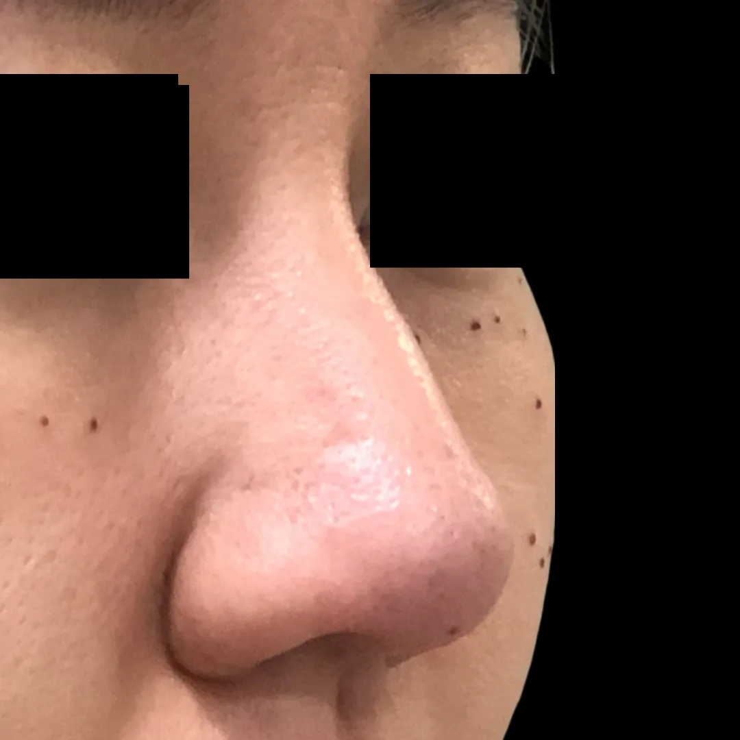 Nose thread lift Petaling Jaya