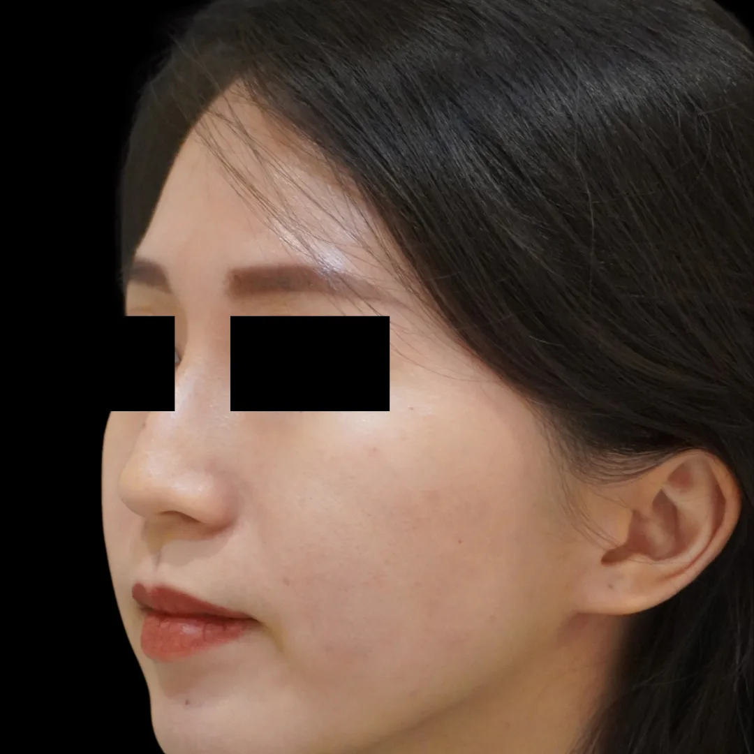 Nose thread lift Petaling Jaya
