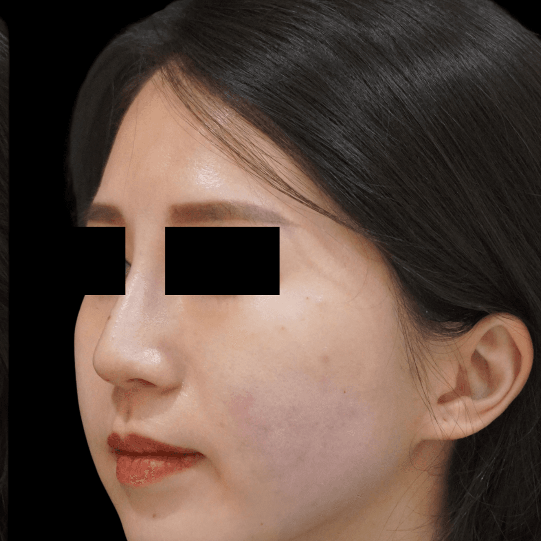 Nose Thread Lift (4)