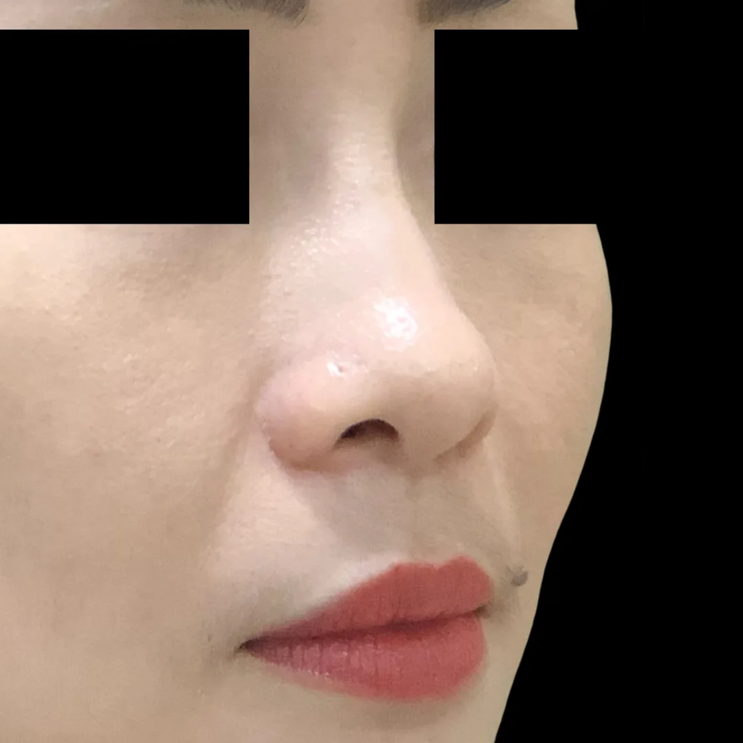 Nose thread lift Petaling Jaya