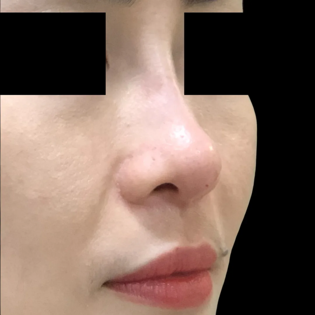 Nose thread lift Petaling Jaya