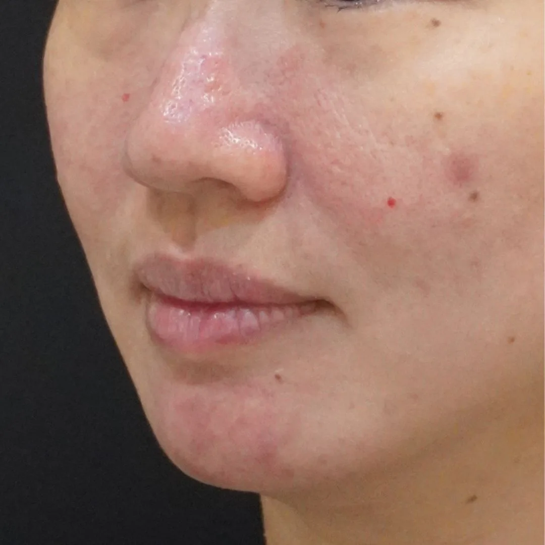 Skin booster Petaling Jaya
