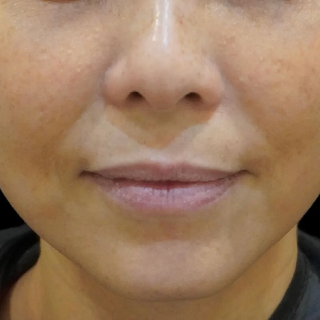 Skin booster Petaling Jaya